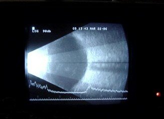 Göz Ultrasonografisi